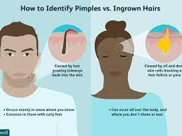 This will remove bacteria and dead skin cells that have or may block the follicles, causing widespread infection. Difference Between A Pimple And An Ingrown Hair