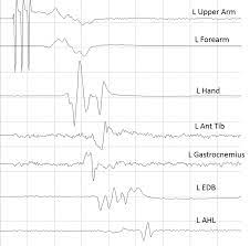 Cureus Direct Cortical Motor Evoked Potentials Versus Transcranial Motor Evoked Potentials For The Detection Of Cortical Ischemia During Supratentorial Craniotomy Case Report