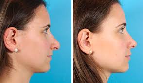 Check spelling or type a new query. Rhinoplasty Toronto Nose Job Cost Ontario Dr Asaria