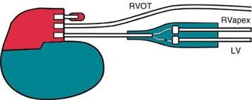 Heart and vascular surgeons generally perform pacemaker and cardioverter. Lead Connections A Y Connector 5866 38m Medtronic Inc Minneapolis Download Scientific Diagram