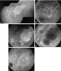 In the united states, choroidal melanoma affects approximately 2500 people per year with. Metastatic Melanoma In The Eye And Orbit Ophthalmology