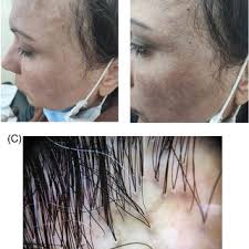 Mesotherapy for Acne before and after Treatment