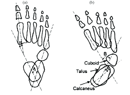 ✓ free for commercial use ✓ high quality images. Top View Of A Normal Foot B Clubfoot 1 Download Scientific Diagram