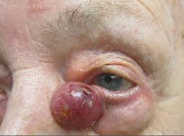 Image result for Merkel Cell Carcinoma
