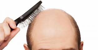 What kind of doctor treats hair loss. Indian Doctors Get Us Patent For Hair Regrowth