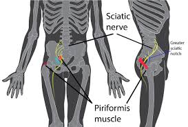 The lower extremity refers to the part of the body from the hip to the toes. Piriformis Syndrome Wikipedia
