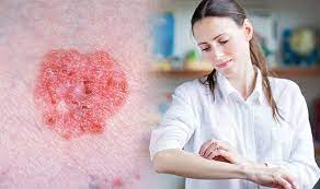 Rough or textured red patches with irregular borders. Skin Cancer Symptoms Six Signs Of Non Melanoma To Look For On Your Body Express Co Uk