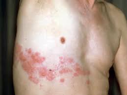 Image result for shingles