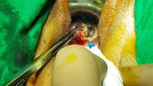 A cervical biopsy is a procedure performed to remove tissue from the cervix to test for abnormal or precancerous conditions, or cervical cancer. Cone Biopsy Cervix Dr Jay Mehta Youtube