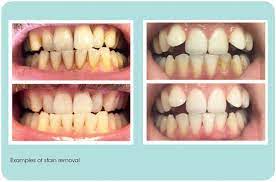 How to remove coffee stains from teeth naturally. Tooth Whitening Versus Stain Removal Bdj Team