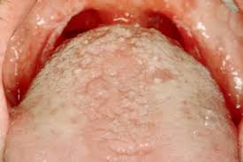 Image result for oral thrush symptoms roof of the mouth
