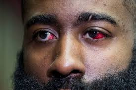 James harden suffers hamstring injury. James Harden Says He Ll Play Game 3 Despite Eye Injury