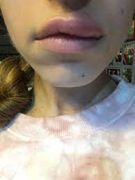 2 ﻿ immediately after getting lip injections, there is some degree of swelling, which is completely normal. Why Did Only One Side Of My Lip Swell Drastically After Lip Fillers Photos