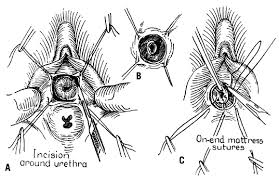 Simple Operations Of The Vulva | Glowm