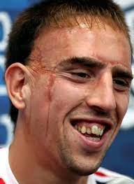 O işi tamamlamak istiyorum dediğini açıkladı. Da Liegst Du Schief Wie Die Zahne Von Franck Ribery Home Facebook
