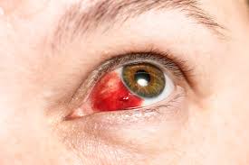 It's the summer and one of the most common questions eye doctors are asked is, is it safe to swim in my contact lenses?. Subconjunctival Hemorrhage Vista Eye Care