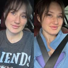 I am looking for a very good plastic surgeon in the Greenville area for  breast implant downsizing ( exchange) and a small lift. I have the cohesive  gel ( gummy bear ones)