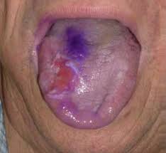 Le placche alla gola sono spesso causate da un'infezione virale, con circa il 40% dei casi dovuti a le placche alla gola, in particolare, si accompagnano alla tonsillite, ovvero un'infiammazione delle. Tumore Della Lingua Diagnosi Terapia Tumore Dott G Spinelli