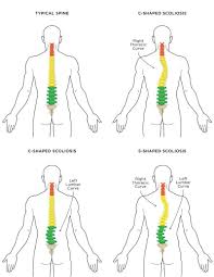 Scoliosis And Yoga The Do S And Don Ts In 2020 Scoliosis Exercises Scoliosis Scoliosis Exercises Stretching