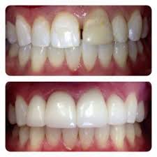 You will have to visit the dentist more than once for this type of veneer. Porcelain Veneers Specialist Castle Hills Lewisville Tx