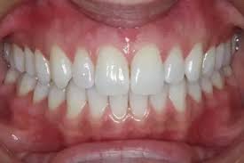 For healthy gums, brush twice a day, floss regularly, pick a fluoride toothpaste, use mouthwash and rinse carefully. What Are Some Signs Of Healthy Gums Quora