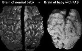 Subscribe to kylee nash's feed and add her as a friend. Comparison Of Brain Of Normal Baby With Brain Of Baby With Fas Download Scientific Diagram