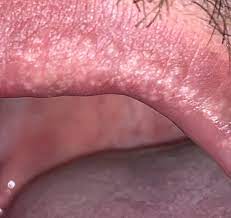 Granitos En Los Labios