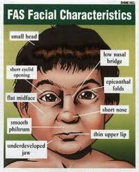 Epicanthal folds appear most frequently in persons with down syndrome and some other constellations of birth defects. Fetal Alcohol Syndrome Fetal Alcohol Fetal Alcohol Syndrome Fetal Alcohol Spectrum Disorder