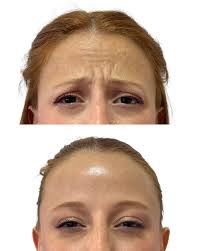 Adiós a las arruguitas indeseadas! 👋 Con mi querida toxina, logramos  suavizar las líneas de expresión para una piel más lisa y juvenil.  😌Siempre buscando resultados que te encanten y manteniendo siempre