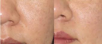 Large Pores Before Left And After 2 Months Download Scientific Diagram
