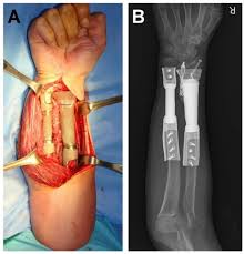 This model is consist of different model conversions such as 3ds, max, maya, lightwave etc. Applied Sciences Free Full Text Integration Of A Three Dimensional Printed Titanium Implant In Human Tissues Case Study Html