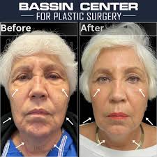 The Bassin Center...