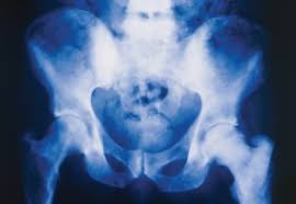 Treating prostate cancer with radiation is a good option for older men with diminished health whose cancer is progressing. New Guideline Issued For Managing Advanced Prostate Cancer Mpr