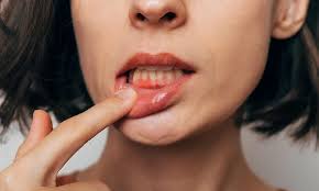 Image result for gum cancer symptoms