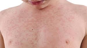 Ketahui penyebab, gejala, ciri, dan obat penyakit lupus! Odapus Saya Sembuh