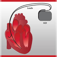 The icd is revised periodically and is currently in its tenth edition. Coping With Your Partner S Icd And Heart Disease Heart Sisters