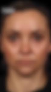 When filler fails, it's time to rethink the approach! 🙌, She’s 42, fit,  and had tried everything to treat her under-eye bags — from fillers to  radiofrequency treatments — but nothing worked. In fact, ...