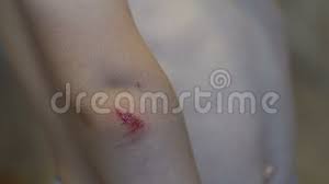 Contrary to what you may think it's not. Close Up Of A Scratch With Blood On The Hand Of A Small Child Stock Video Video Of Bruise Knee 152600757