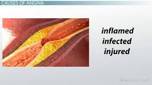 Image result for Angina Pectoris