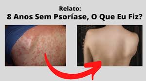 Meu depoimento, minhas dicas e receitas. 8 Anos Sem Psoriase Meu Relato Youtube