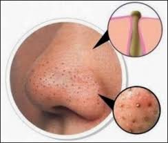 Lemon kaya akan vitamin c. Pengedar Shaklee Sekinchan Selangor Cara Berkesan Hilangkan Bintik Hitam Di Hidung