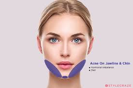 Acne Face Map What Is Your Acne Trying To Tell You