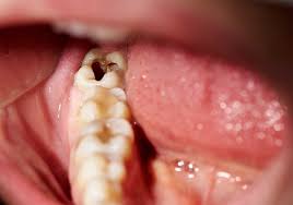 Check spelling or type a new query. Tooth Decay Causes Treatment Prevention Of Decay And Tooth Loss
