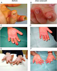 Boost stamina, improves erection, increases blood flow Digital Ulcer Healing By Sildenafil Treatment As Shown For Three Download Scientific Diagram