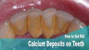 Only a dental professional can remove tartar buildup on your teeth. Calcium Deposits On Teeth Teethwalls