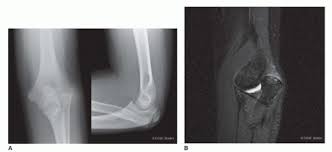 Image result for Radial Head Dislocation