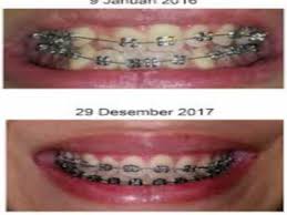 Pasang Behel Perawatan Gigi Behel Fashion Jogja Gigi Perawatan Kecantikan