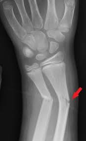 Image result for Fractures in Children