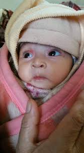 5-month-old baby girl from Ghanche needs funds to undergo heart surgery The  family of a five-month-old baby girl, who has a hole in her heart-Large  Outlet Vascular VSD, have appealed for donations