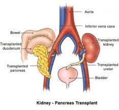 Pancreas Kidney Transplant Kidney Pancreas Transplant Showing Bowel Transplanted Duodenum Kidney Biopsy Kidney Pancreas